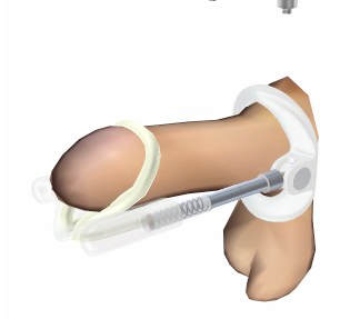 Illustration for article titled The (dubious) science of penis enlargement